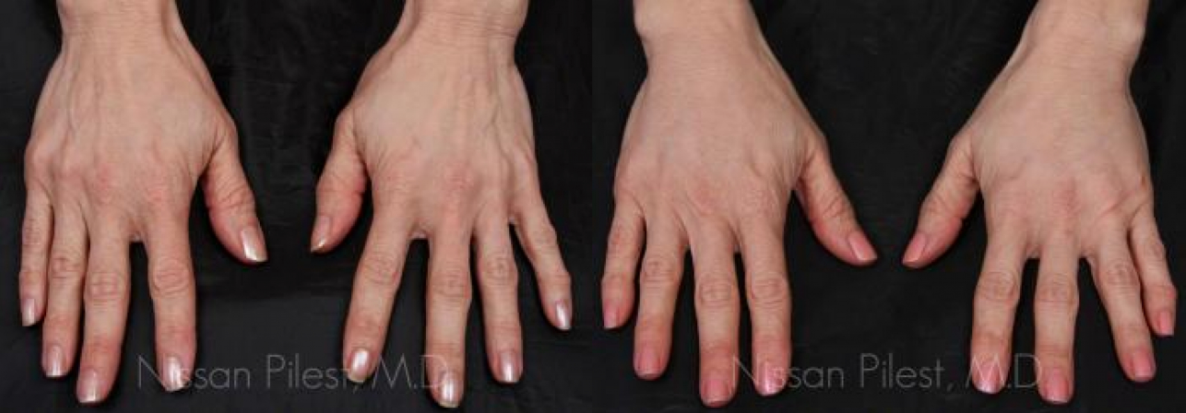 Irvine Hand Treatment Before & After
