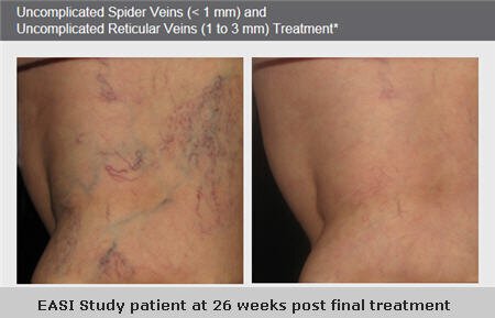 Irvine Sclerotherapy Before and after for leg veins