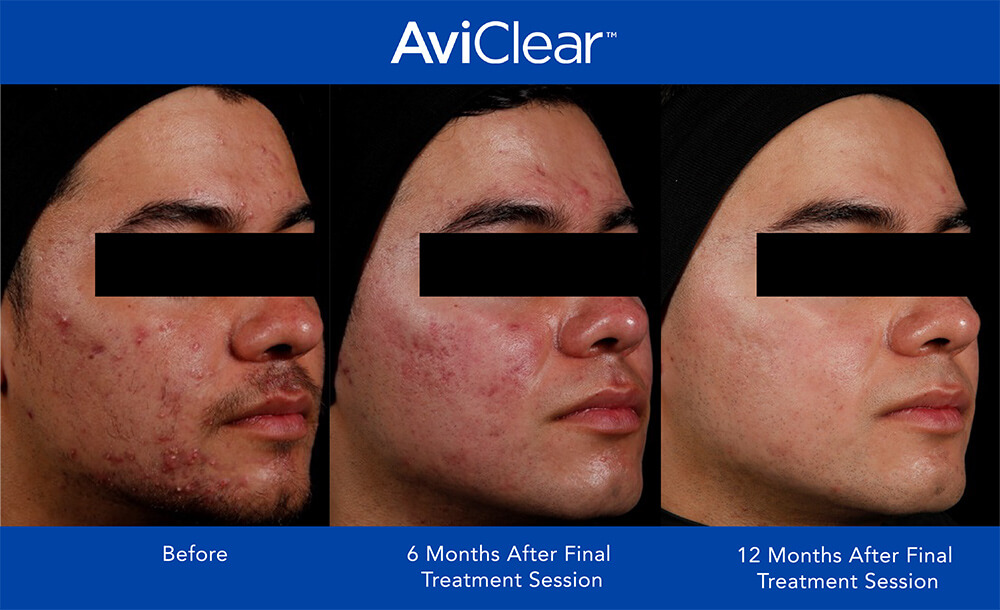 aviclear before and after featured image