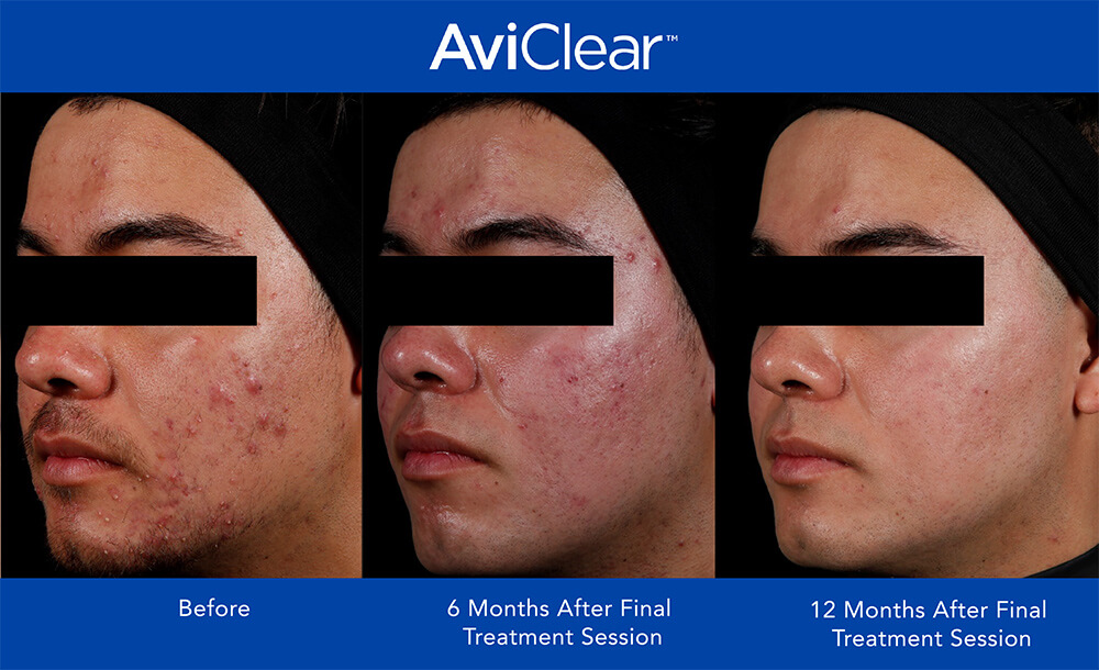 aviclear before and after featured image