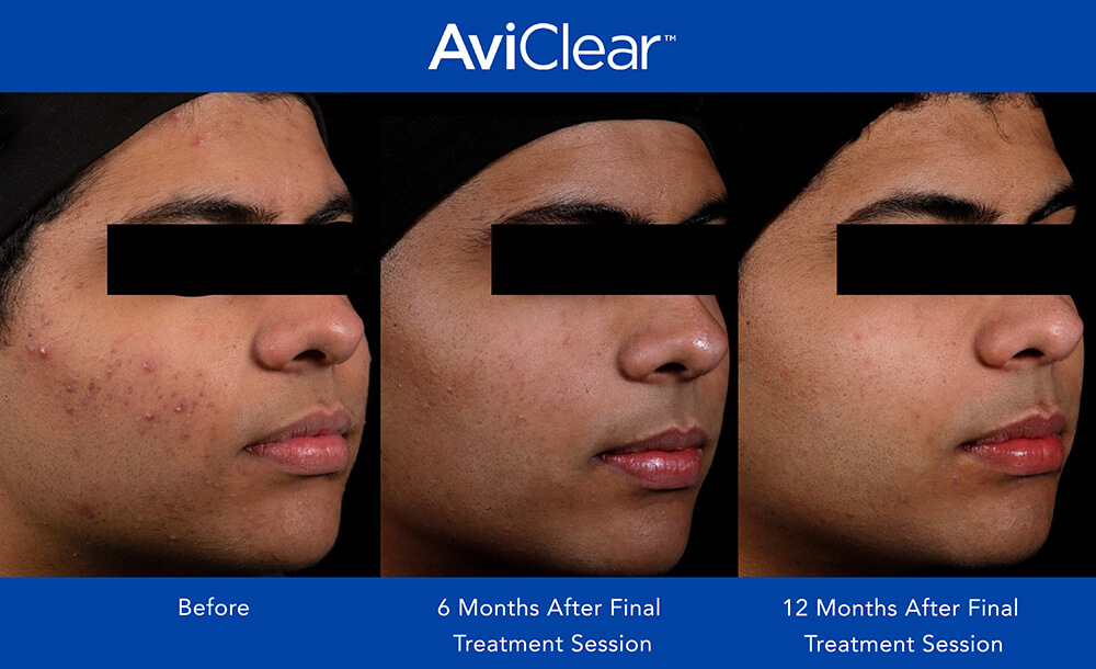 aviclear before and after featured image