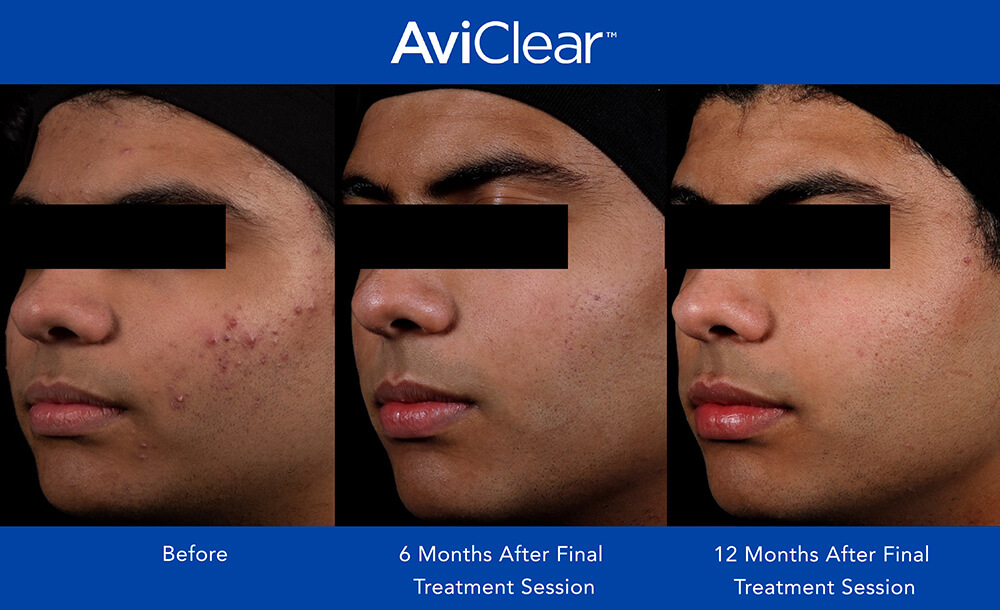 aviclear before and after featured image