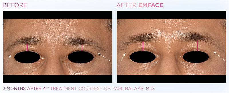 Irvine EmFace patient before and after