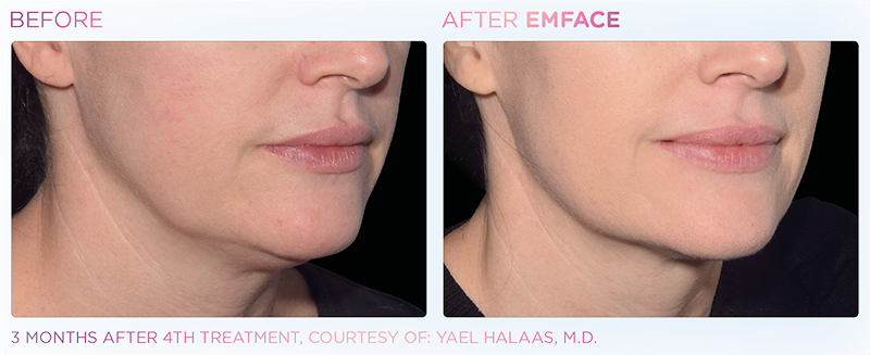 Irvine EmFace patient before and after