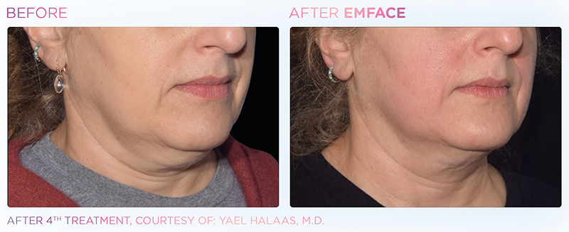 Irvine EmFace patient before and after