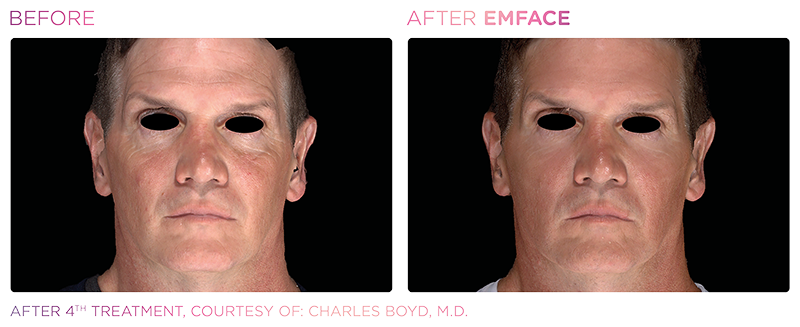 Irvine EmFace patient before and after