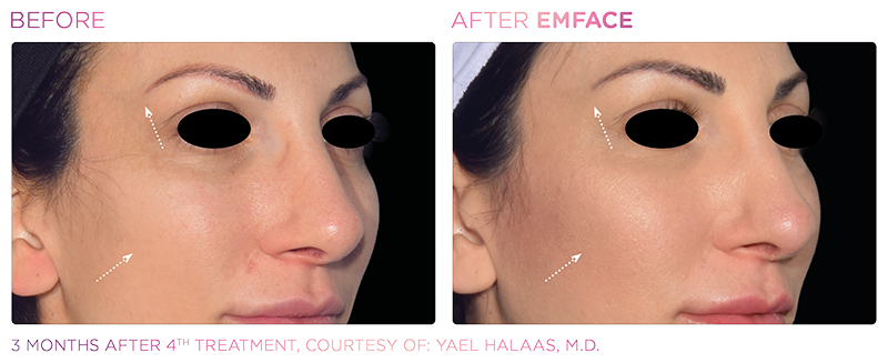 Irvine EmFace patient before and after