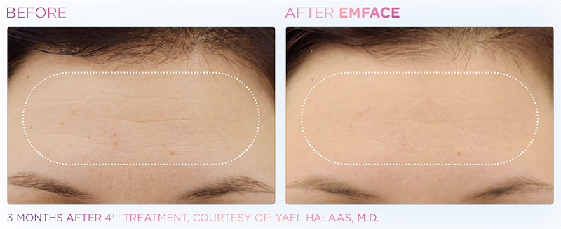 Irvine EmFace patient before and after