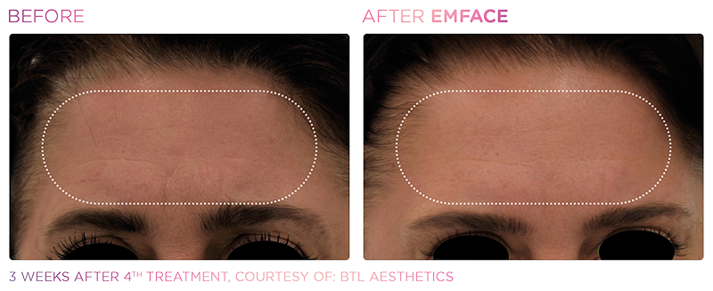 Irvine EmFace patient before and after