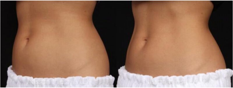CoolSculpting Before & After Irvine, CA