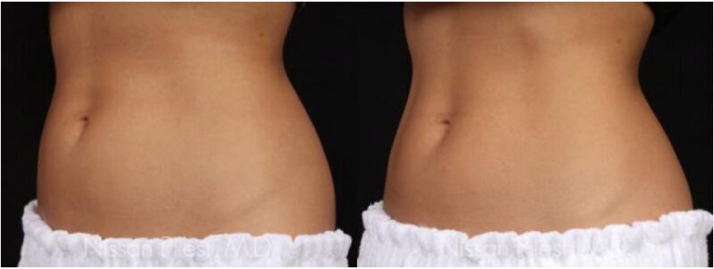 Irvine CoolSculpting Before & After