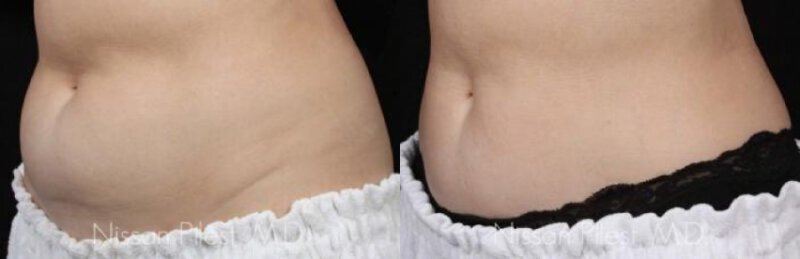 Irvine CoolSculpting Before & After