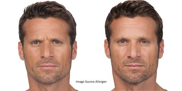 Botox Man Before and After Irvine, CA