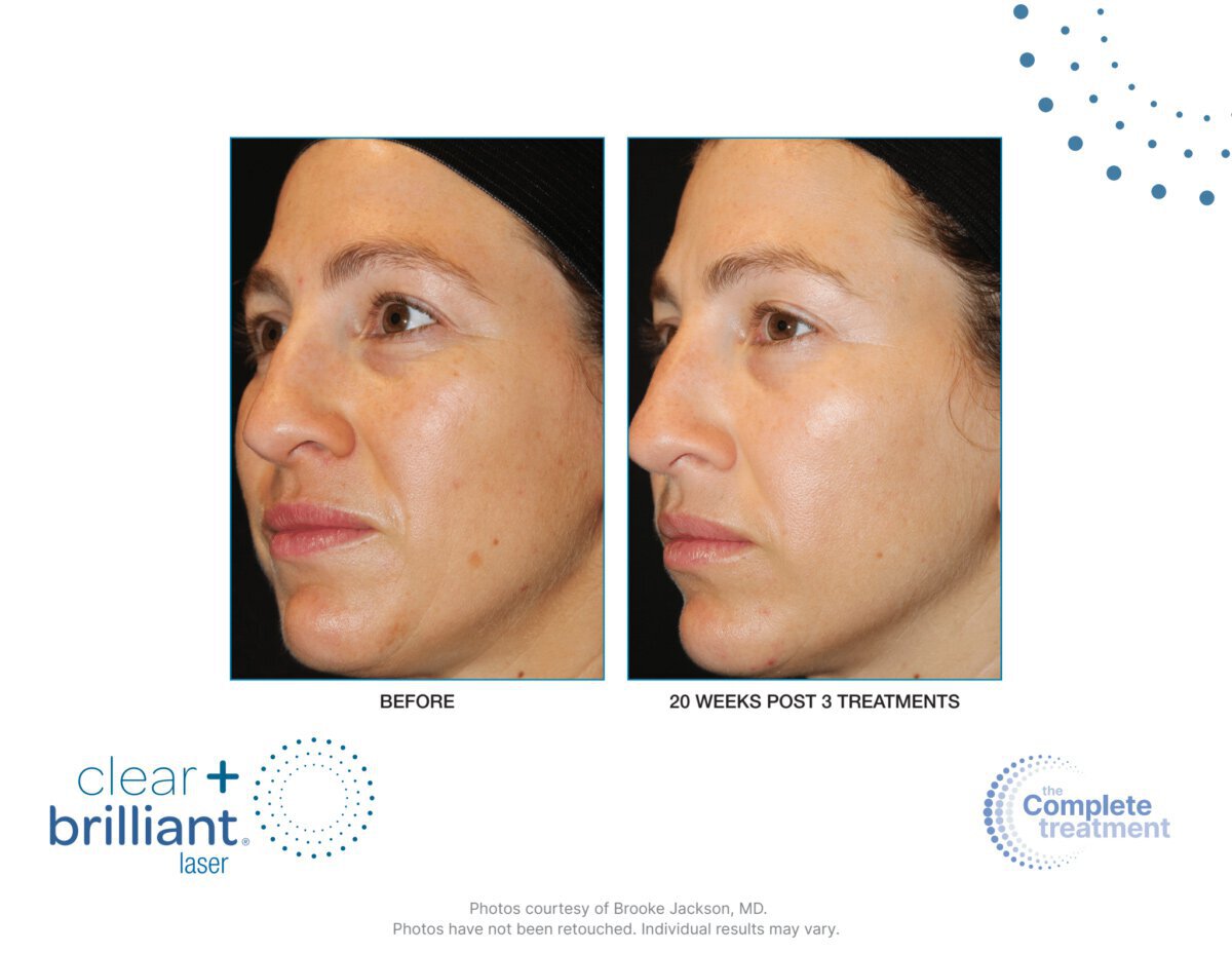 Irvine melasma treatment patient before and after