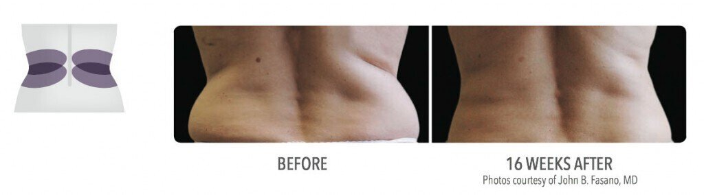 CoolSculpting Transformation  Cool sculpting, Medical aesthetic