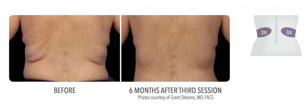 CoolSculpting Transformation  Cool sculpting, Medical aesthetic