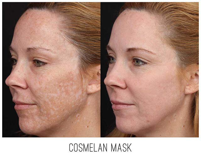 COSMELAN Peel Before & After Irvine, CA