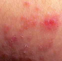 eczema-patch