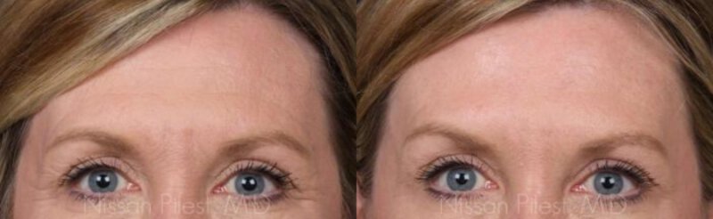 Dysport Injections Before & After Irvine, CA