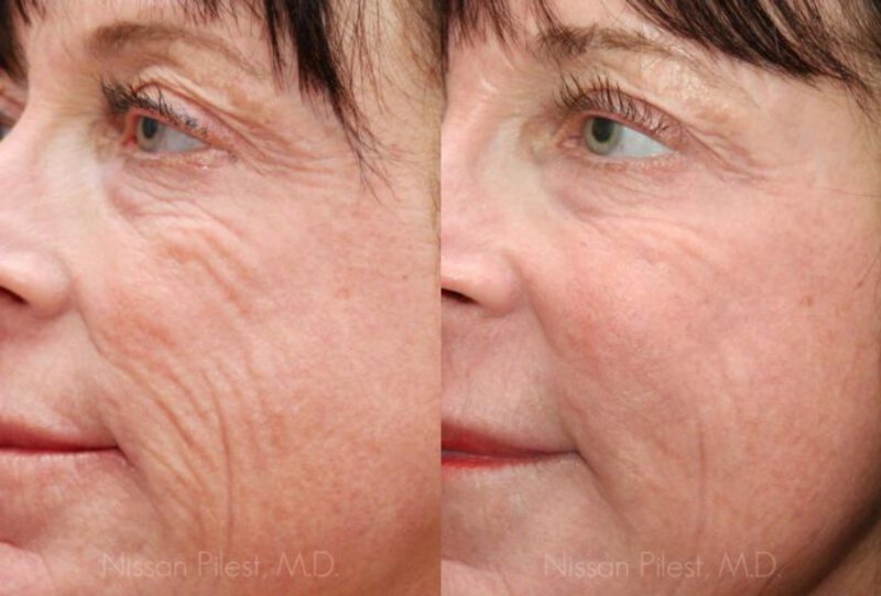Dysport Injections Before & After Irvine, CA