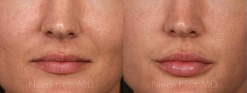 Juvederm Ultra Before & After Irvine, CA