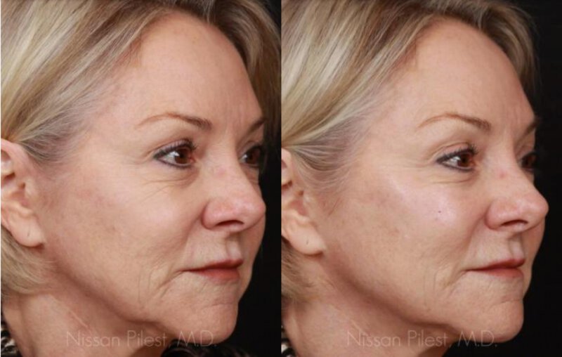 Juvederm VOLUMA Before & After Irvine, CA