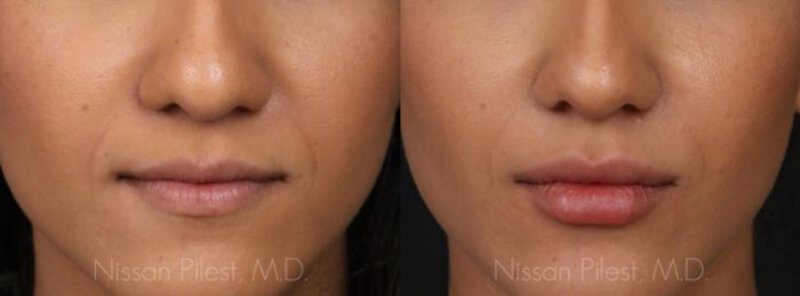 Juvederm Ultra Before & After Irvine, CA