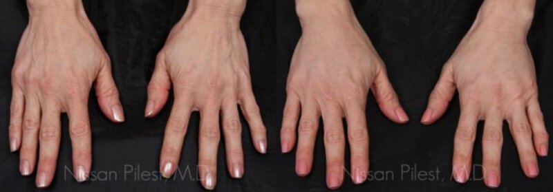 Radiesse Hand Treatment Before & After Irvine, CA