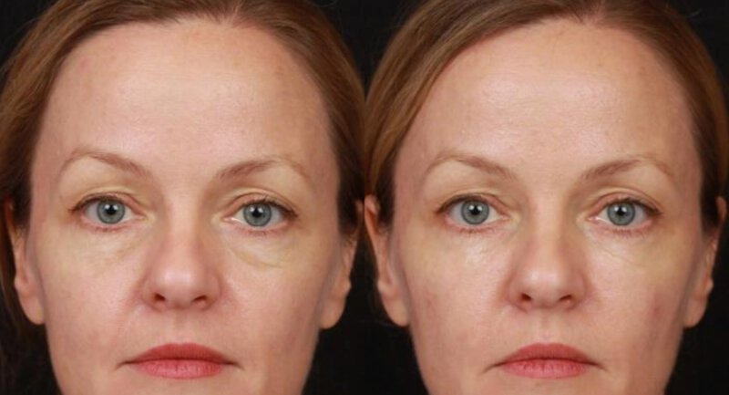 Restylane Before & After Irvine, CA