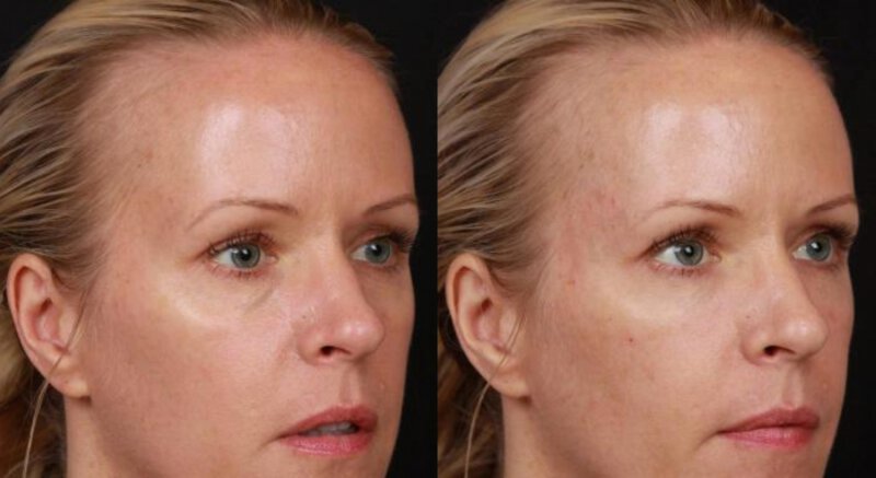 Restylane Before & After Irvine, CA