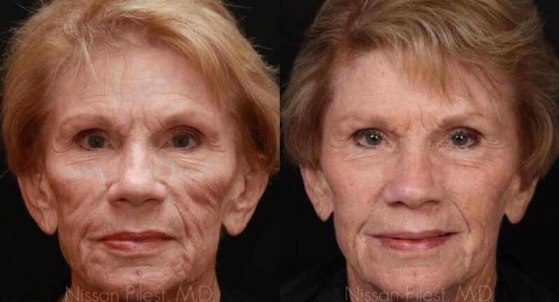 Sculptra Before & After Irvine, CA