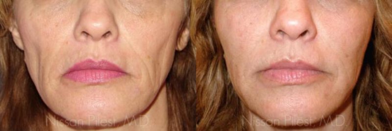 Sculptra Before & After Irvine, CA