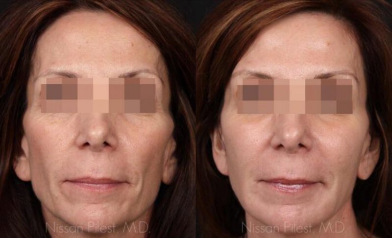 Sculptra Before & After Irvine, CA