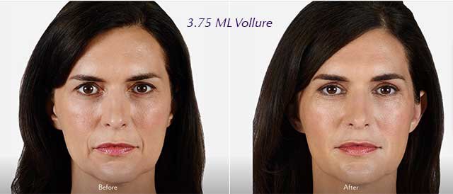 Juvederm Vollure Before & After Irvine, CA