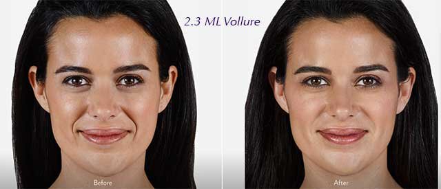 Juvederm Vollure Before & After Irvine, CA