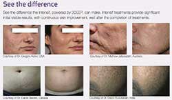 Examples of microneedling results