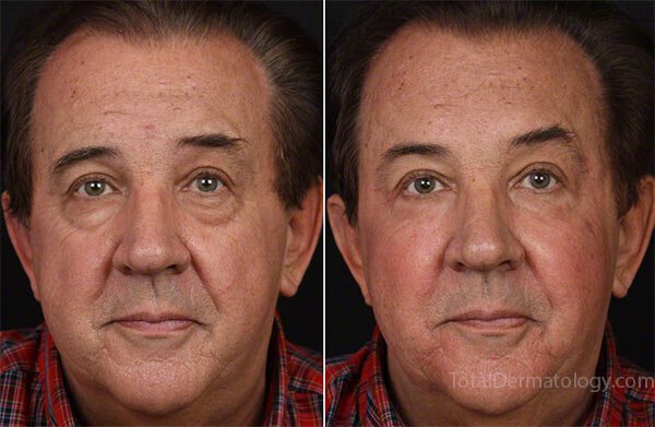Facial Folds Treatment For Men Before & After Irvine, CA