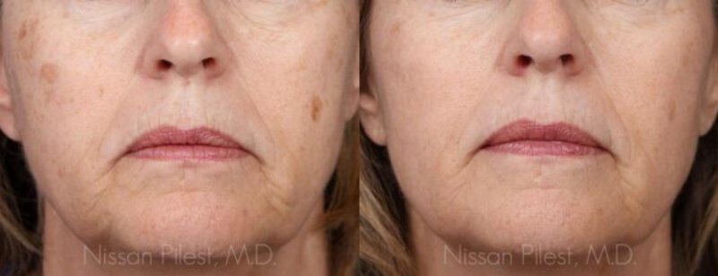 Irvine Alex TriVantage Laser Before & After