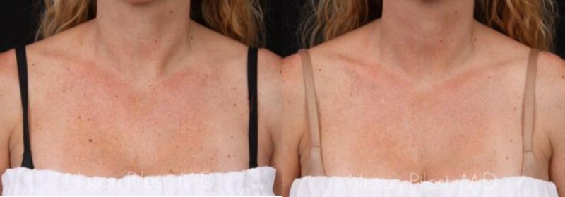 Irvine Alex TriVantage Laser Before & After