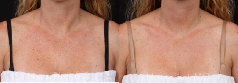 Irvine Alex TriVantage Laser Before & After