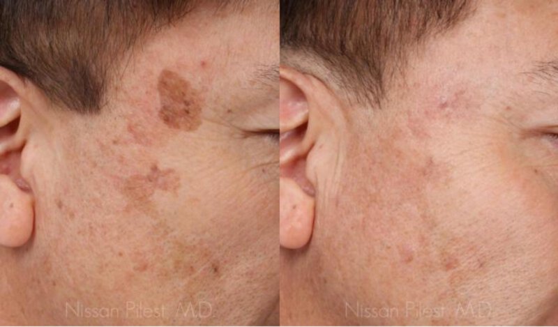 Irvine Alex TriVantage Laser Before & After