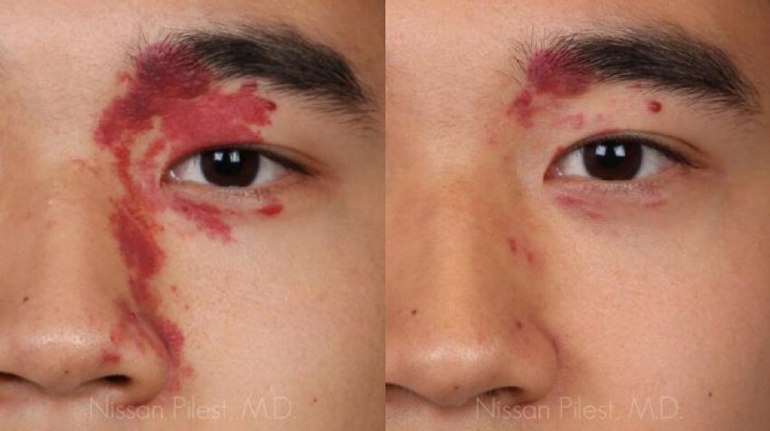 Irvine Facial Vein treatment Before & After