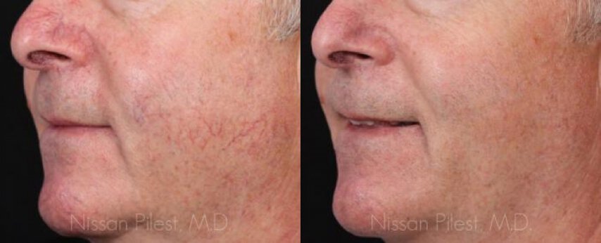 Irvine facial vein treatment Before & After