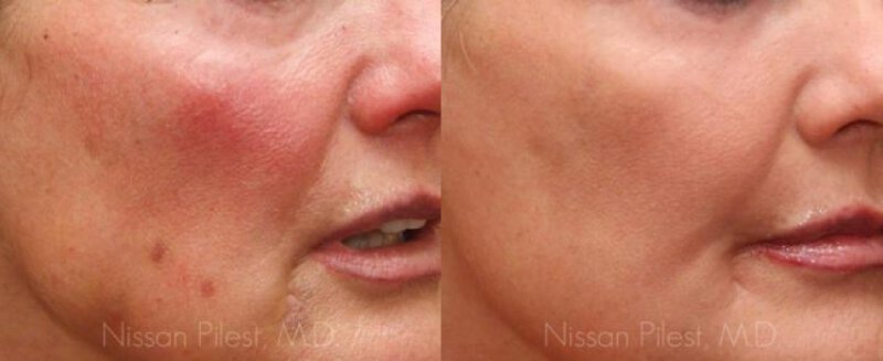 Fractional CO2 Laser, Fraxel & ProFractional in Irvine