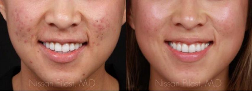 Irvine SmoothBeam Laser Before & After