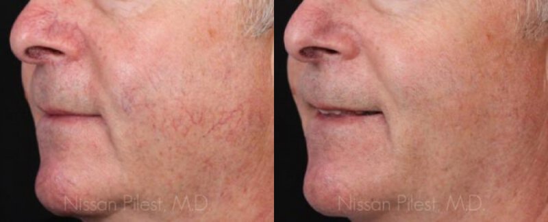 Irvine Vbeam Laser Before & After