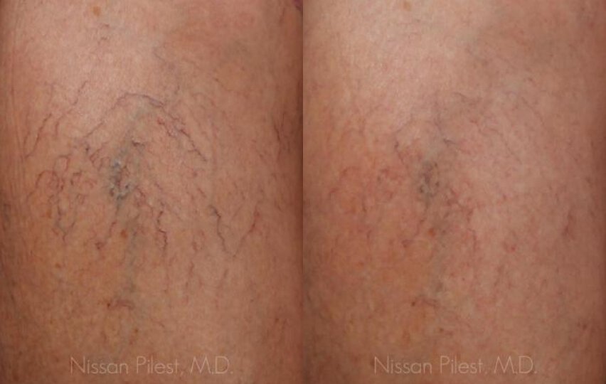 Leg Vein Treatment Before & After Irvine, CA