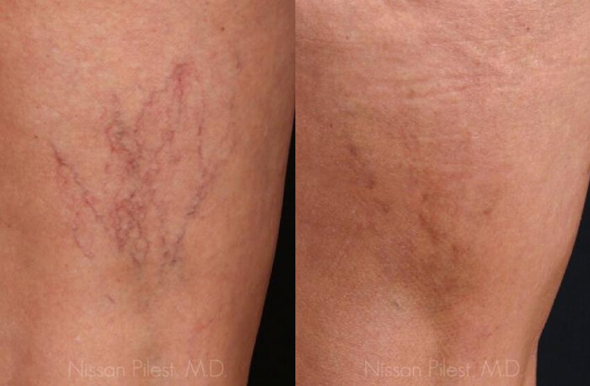 Leg Vein Treatment Before & After Irvine, CA