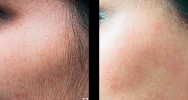 Irvine Laser Hair Removal Before & After