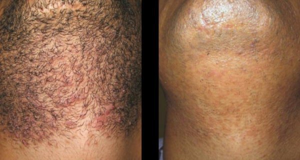 Irvine Laser Hair Removal Before & After